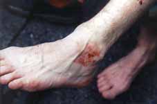 Post-hike, my leech damaged feet. (Category:  Travel)
