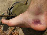 My ankle three days after the injury. (Category:  Rock Climbing)