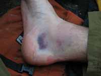 My ankle one day after being injured. (Category:  Rock Climbing)
