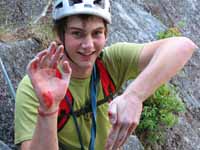 After the fall:  Some blood. (Category:  Rock Climbing)