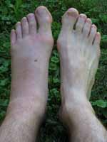 My hideously swollen foot about 28 hours after a bee sting. (Category:  Party)