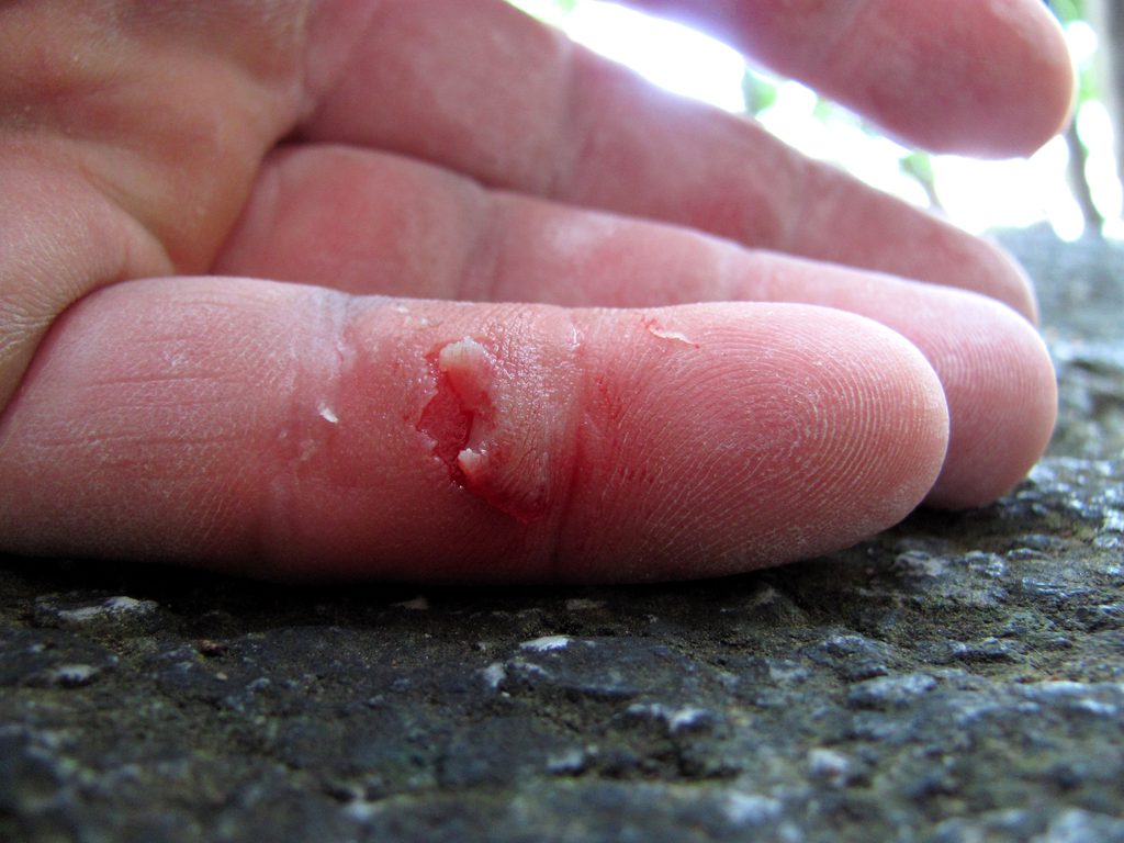 My flapper after rinsing the blood. (Category:  Rock Climbing)