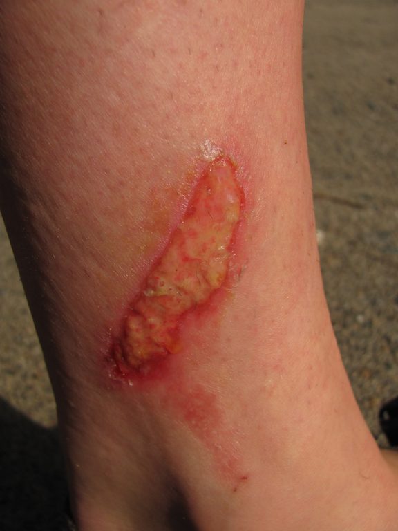 Anna's rope burn. (Category:  Rock Climbing)