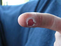 Katie trashed her finger on RMC. (Category:  Rock Climbing)