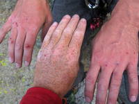 Our hands after three days of climbing at Devil's Tower. (Category:  Rock Climbing)